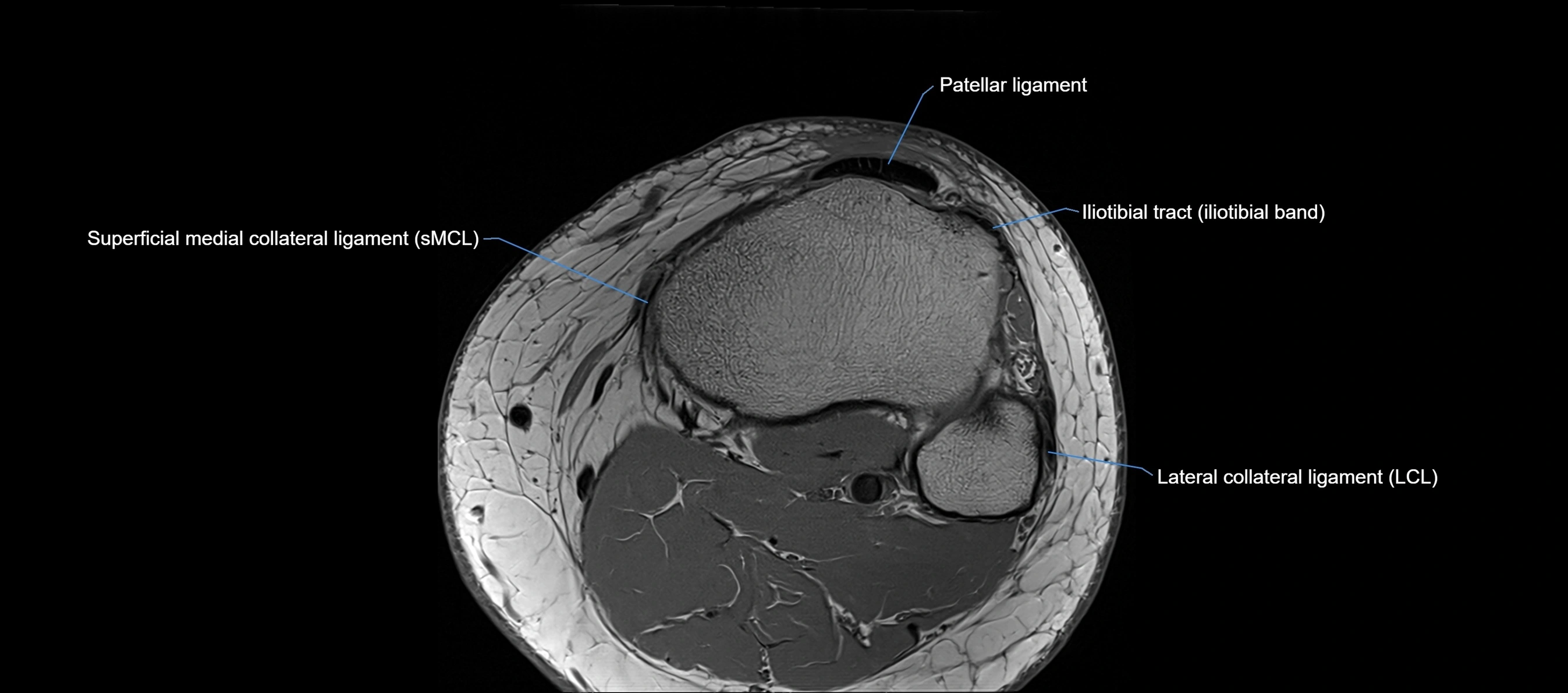 MRI Knee axial  ligaments cross sectional anatomy 3T  radiology  image-img-03001-00041.webp